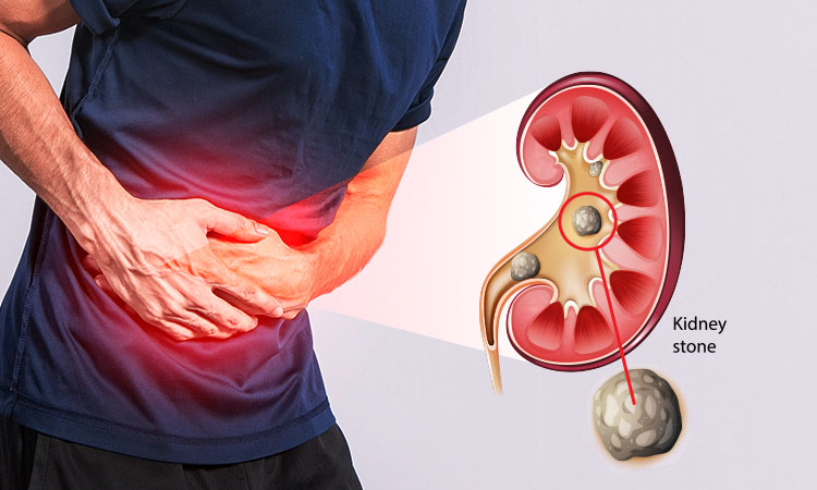 Kidney Stone Prevention : क्या आप भी पथरी से बचने के लिए खूब पानी पीते हैं? पहले जान लें यह रिपोर्ट Kidney Stone Prevention : क्या आप भी पथरी से बचने के लिए खूब पानी पीते हैं? पहले जान लें यह रिपोर्ट