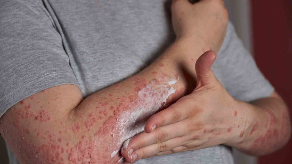 Psoriasis Symptoms and Skin Care Tips : त्वचा पर खुजली और लाल चकत्तों को न समझें मामूली एलर्जी, हो सकता है गंभीर बीमारी का संकेत Psoriasis Symptoms and Skin Care Tips : त्वचा पर खुजली और लाल चकत्तों को न समझें मामूली एलर्जी, हो सकता है गंभीर बीमारी का संकेत